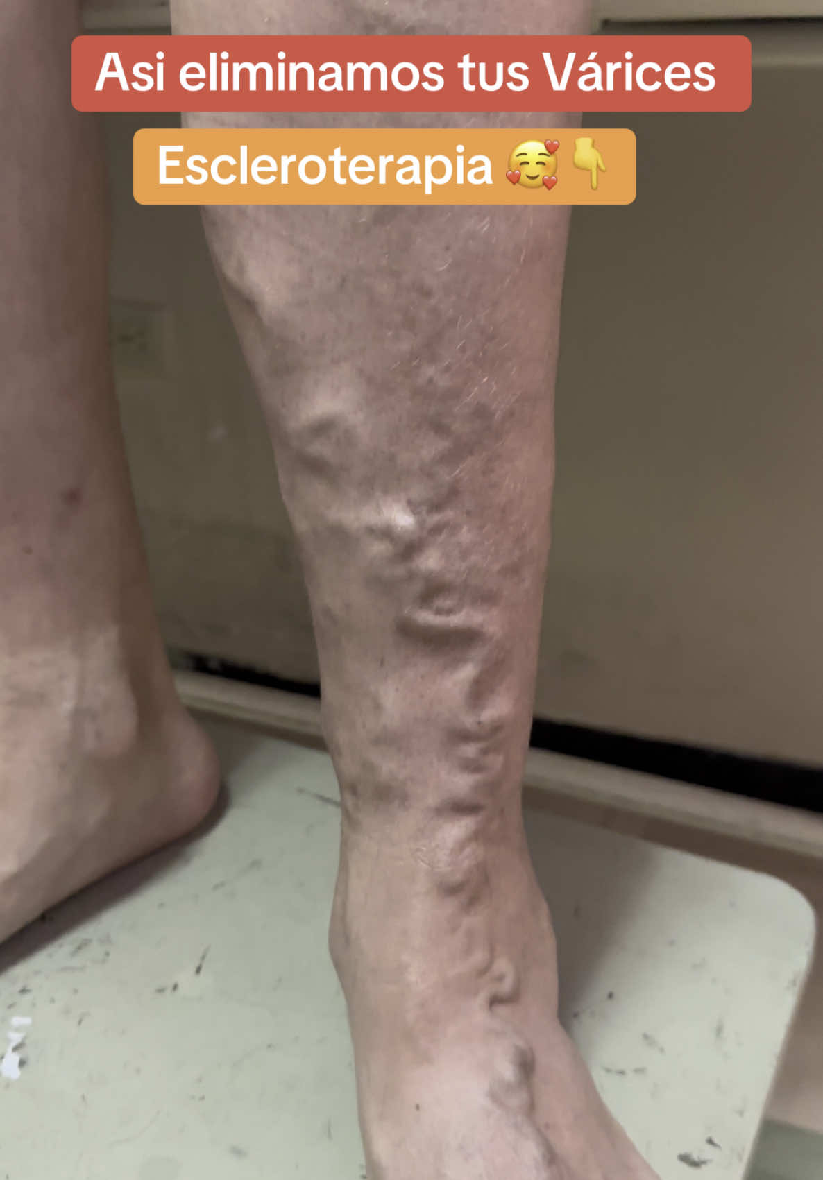 🏩 La Escleroterapia 🥰👆 es una excelente opción para eliminar tus Várices siempre y cuando estas no sean quirúrgicas es decir no haya un daño de venas safenas 😎 Se hace en el consultorio médico , no necesita cortes , no deja cicatrices y te incorporas a tus actividades de manera inmediata @The Vein Doctor 👨‍⚕️ 👉 Riovasc 👈📲+593995178395/+593995178395 #escleroterapia #varices #varicesenlaspiernas #venasvaricosas #arañasvasculares #varicesyarañitas #cristianbravo148 #cirugiavascular 