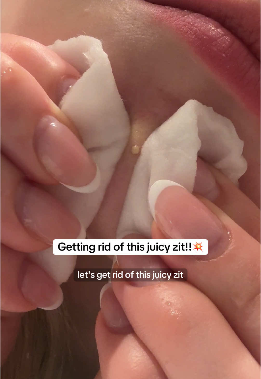 If you’re like me and have no patience - don’t worry, I gotchu! Heal your pimple by using a gentle low pH cleanser, the Mugtree Cleanser from @WHIPPED is MY GO-TO ❤️ ad #whipped #whippedcleanser #pimplepopping #pimple #acne #zit #pimplepopper #cleanser #pimpleaftercare #acnetreatment #acneskin #koreanskincare 