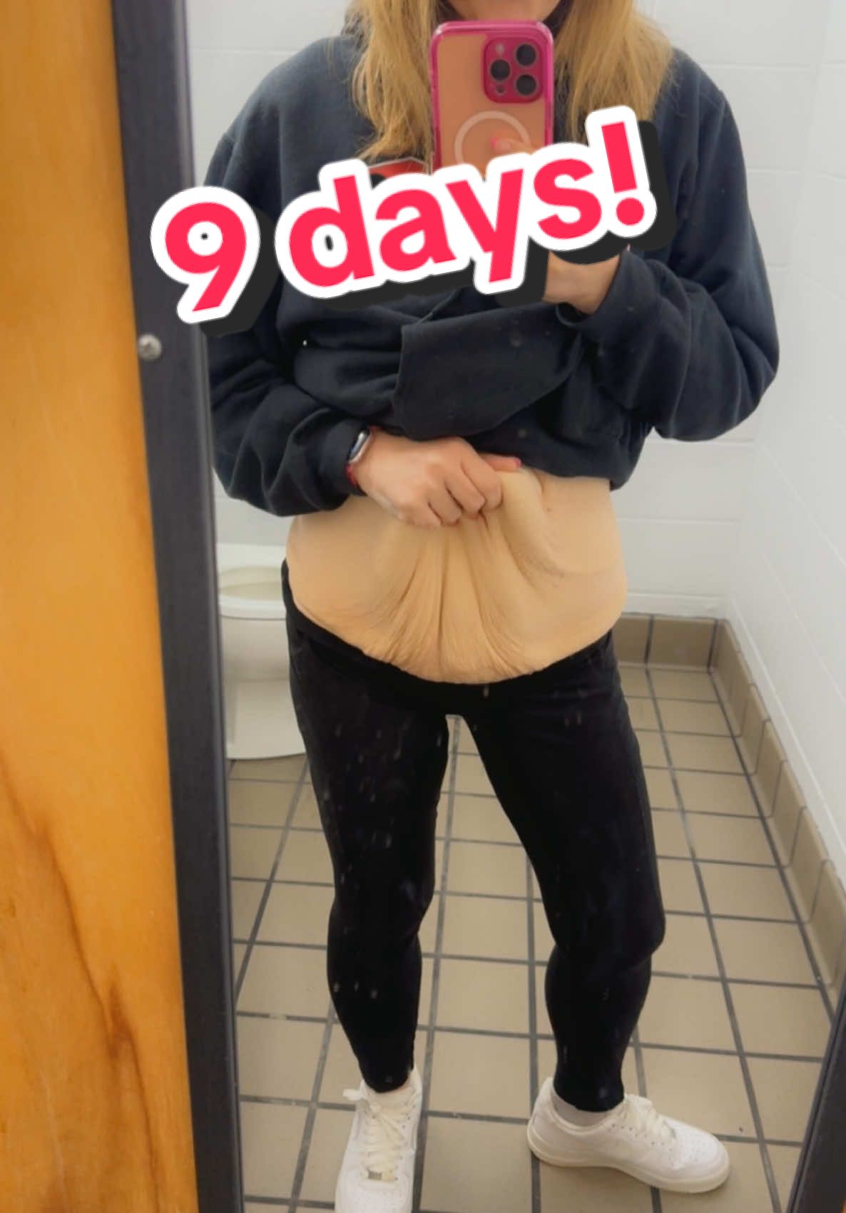 9 more days! #countdown #looseskinremoval #fdlpanniculectomy #vanderbilt #plasticsurgery 