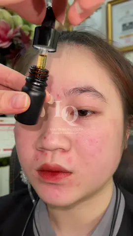 Peel tại nhà #chamsocdamun#chamsocdaseo#chamsocda#chamsocdamun#chamsocdaseo#chamsocdanam#tanbinh#govap #Lequynh#Lqspa#hocnghespa  #chamsocda #lequynhspa #lequynhsp#lqspabeautyacdemyahcm#vienthammylqspa #nanmunbangtay #nanmunbangtambong #nanmunbangcay
