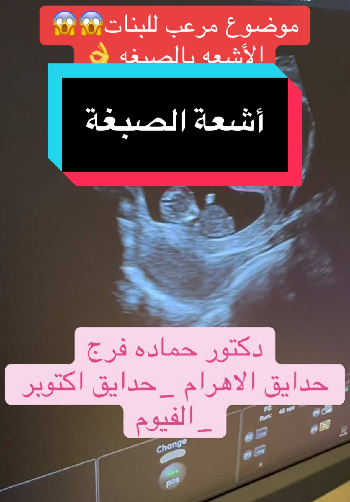 موضوع مرعب جدا لكن مهم جدا جدا لكل البنات ولازم كل اللي يتأخرو في الحمل يعملوه #أشعة_بالصبغة_الرحم_والأنابيب  #حمل  #تأخر_الحمل  #تأخر_الانجاب  #دكتور_حماده_فرج  #سونارالحمل  #سونار_4d  #دكتور_نساء_وتوليد  #حدايق_الاهرام  #حدايق_اكتوبر  #الفيوم  #السعوديه  #الرياض  #جده  #الكويت🇰🇼  