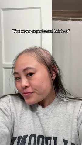 trust me, I can definitely show you 😅 #alopecia #hairloss #hairlossjourney #hairjourney #hair #alopeciaawareness #alopeciaareata #stresshairloss #diffusealopecia #telogeneffluvium 