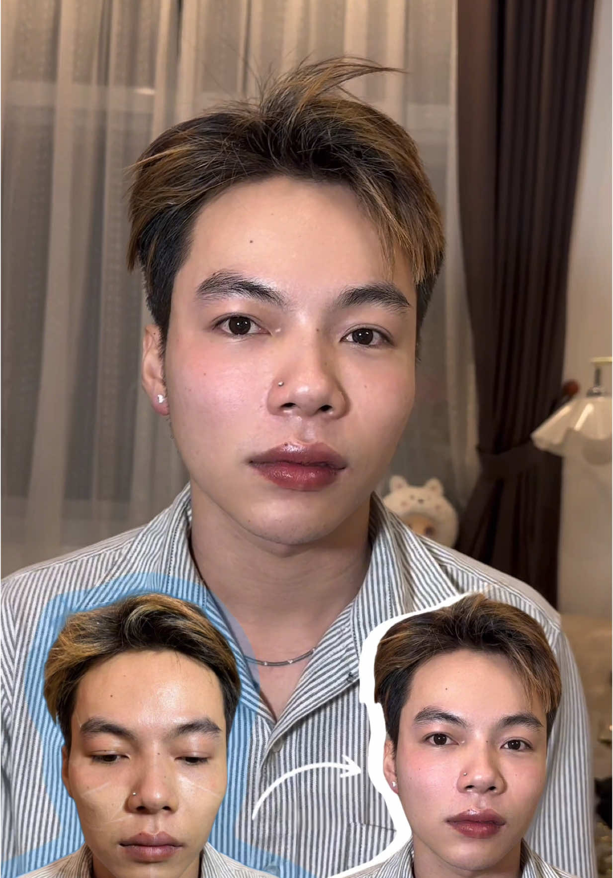 Ai nói con trai là ko được đẹp bao giờ, nét đẹp nam tính 😘 #tiemfillerdepsg  #daotaohocvien  #canchinhfullface  #fillerbotox  #Filler 