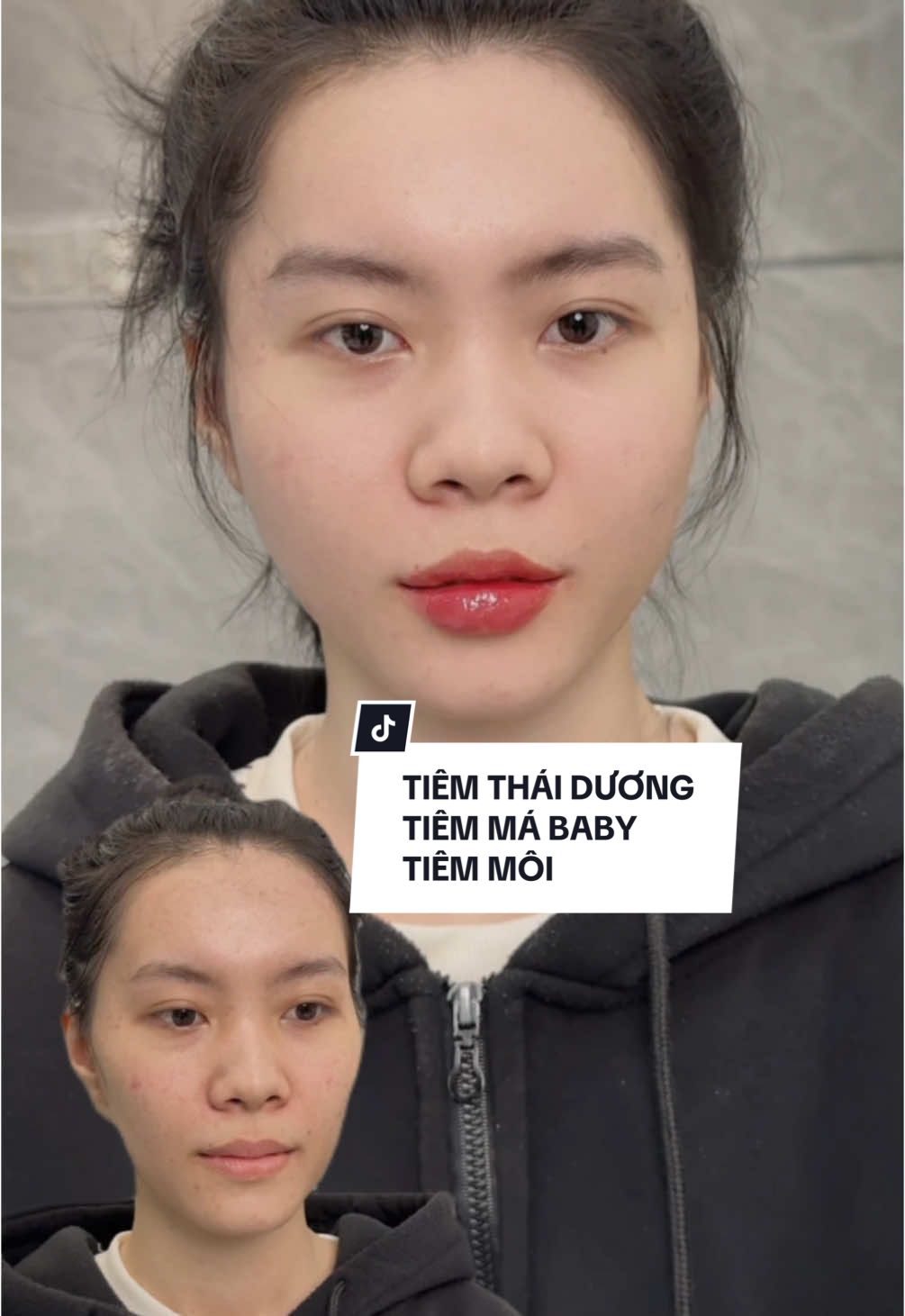 Tiêm filler má baby thái dương môi nhìn ít vậy thôi chứ tiêm lên xinh hẳn #thưthưbeautycenter #fillerbotox #phanthiet #tiêmmábaby #tiemmoi 