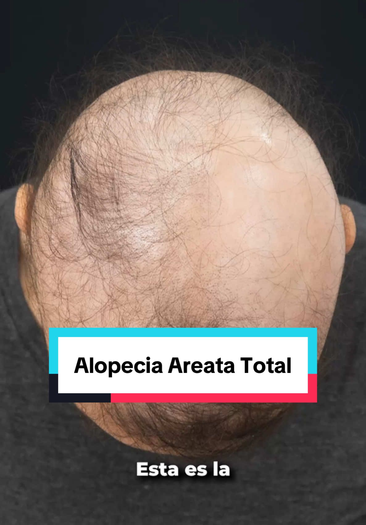 Alopecia Areata Total… Esta paciente perdió casi todo su cabello, pero nunca perdió la esperanza. Después de meses de tratamiento, el cambio es evidente. Cuando hay diagnóstico y tratamiento oportuno, el pelo vuelve. ¡No todo está perdido!” #alopeciaareata #alopeciatotal #dermatologoQuito #tricologoQuito #calvicie #caidadecabello #resultadosreales #antesydespues #minoxidil #dutasteride #dermatologia #hairloss #esperanza #tratamientocapilar #recuperandocabello #alopecia