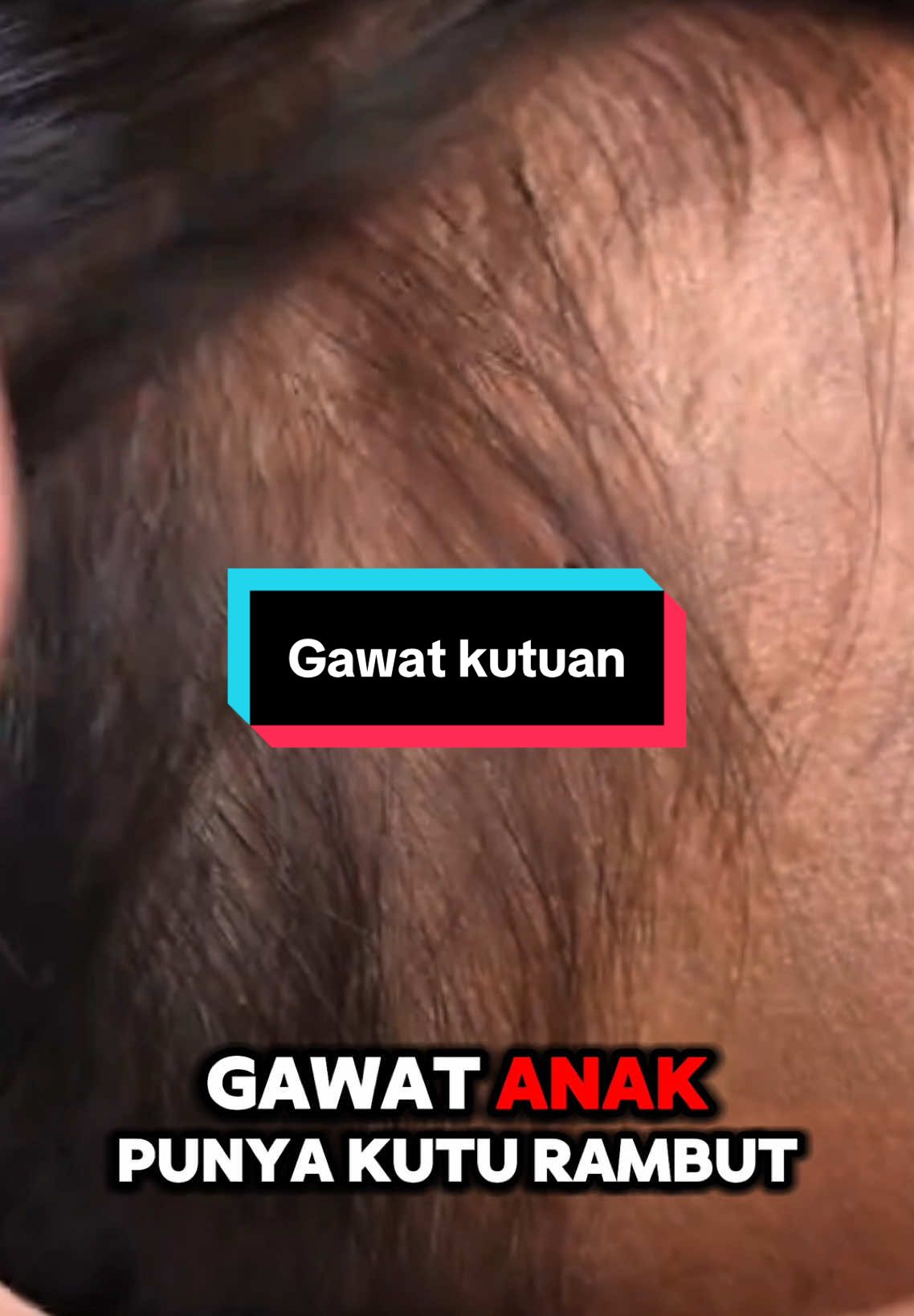 Siapa yang rambut anaknya kutuan?😭😭😭 #kuturambut #pembasmikutu #WIGGAJIAN #minyakkuturambut #obatkutu #captigajempol 