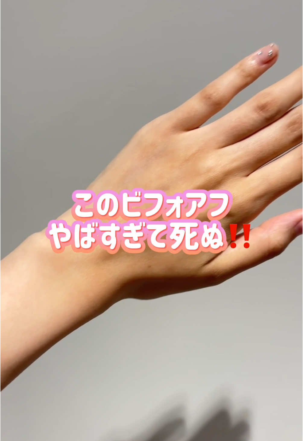 見てこのビフォアフ‼️ここまで白くなるなんて、流石に奇跡で死ぬ‼️ホワイトルマン、私のプロフにあるリンクからが1番安いらしい🩷 #美白 #日焼け止め #ホワイトルマン #シミ #毛穴 #脂性肌 #ホリデーツイスト #しぬ界隈 #pr 