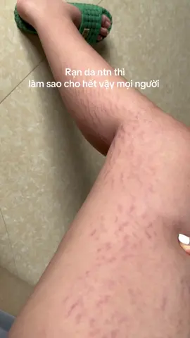 Bị rạn da thì phải lm ntn? #trithamjiuhe #xuhuongtiktok #review 