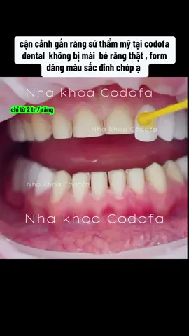 #răng_sứ_thẩm_mỹ #dánsứveneer #khôngmài_nhỏ_răng #trám_răng_thưa #trámrăng_sứt_mẻ #trám_răng_sâu #nhakhoacodofa #lấycaorăng #trám_răng_chuột #trám_tam_giác_đen #nhakhoauytin 