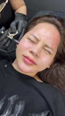 Câu hỏi cho các bà là tiêm meso có đau không nhé #meso #fyp #hieuanhfiller #lamdep #nhậntiemtainha #xuhuongtiktok 