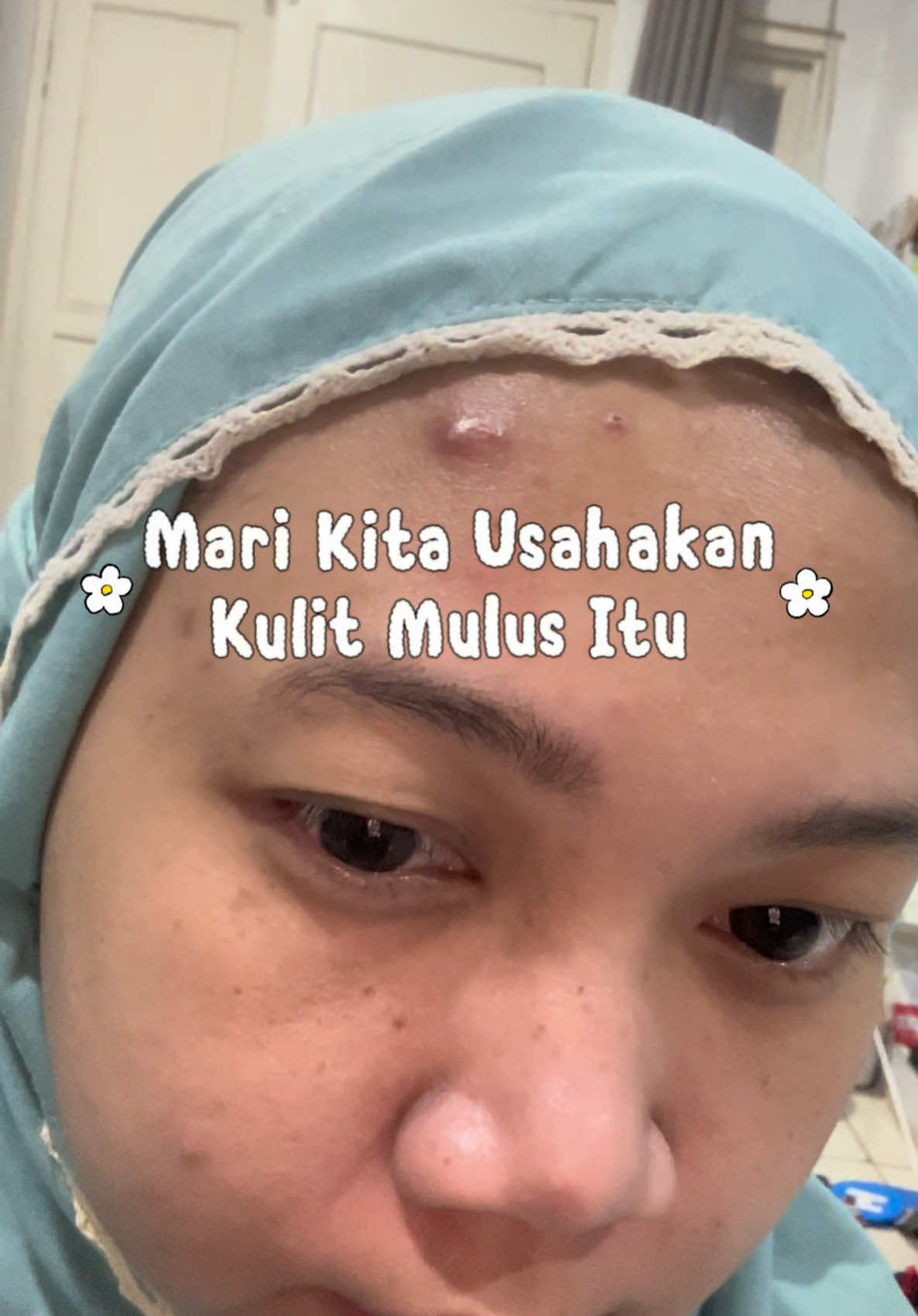 hempas komedo2 & jerawaat ituuh ✨😍 #acnetreatment #acneskin #beauty #drleoid #drleoid #drleoacneessence #drleoclaymask #skincareindonesia 