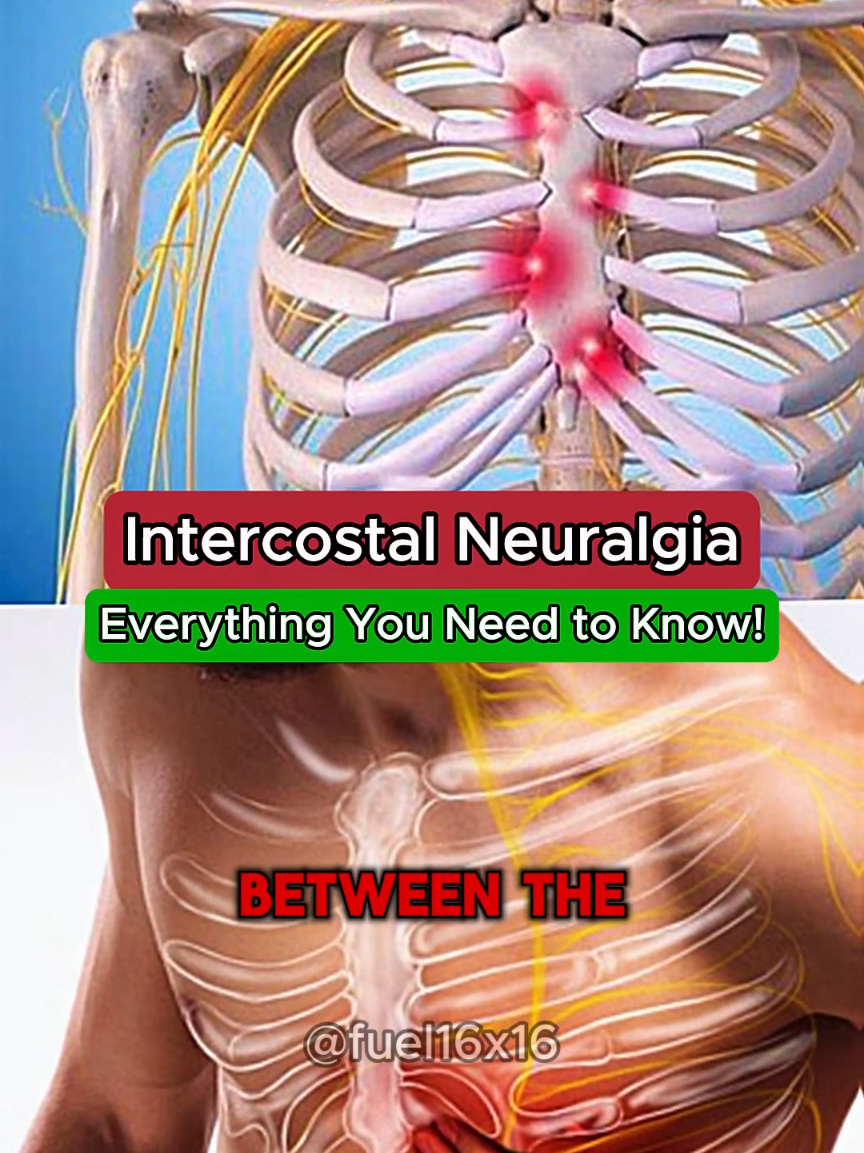 Intercostal Neuralgia..  #intercostalneuralgia #ribpain #healthtips #hospital  #causes #symptoms #health #medical #medicine #anatomy #3d