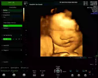 Mặc kệ Mỹ-Trung , Nga - Ú, bác sĩ Nga chỉ có một niềm quan tâm duy nhất đó là sức khỏe và niềm hạnh phúc của mẹ bầu và bé thôi ạ.  Một em bé chúm chím trong bụng mẹ ạ. Phòng khám Sản - Phụ khoa Anh Nga ( NE8,Mỹ Phước 3, Thới Hòa, Bến Cát, Bình Dương ) Phụ trách: Bác sĩ CK1 San-Phụ khoa Đơn vị công tác chính: Bệnh viện 512 giường ( đa khoa tỉnh Bình Dương ) Được sự tin tưởng cộng tác chuyên môn cùng các bệnh viện lớn trong khu vực tỉnh Bình Dương: Bệnh viện Hạnh Phúc, Bệnh viện Cây Dừa,Bệnh viện Columbia , Bệnh viện Hoàn Mỹ... #bệnh viện 512 giường #512giuong #bầuvẫnphảixinh #bầubí #bầu #sieuamthai #sieuam5d #sieuam #phukhoa #phunu #phụnữ #bencatbinhduong #bencat #bencat_binhduong #myphuoc#myphuoc3 #myphuoc3thoihoa #bếncát #bếncatbinhduong #bìnhdương 