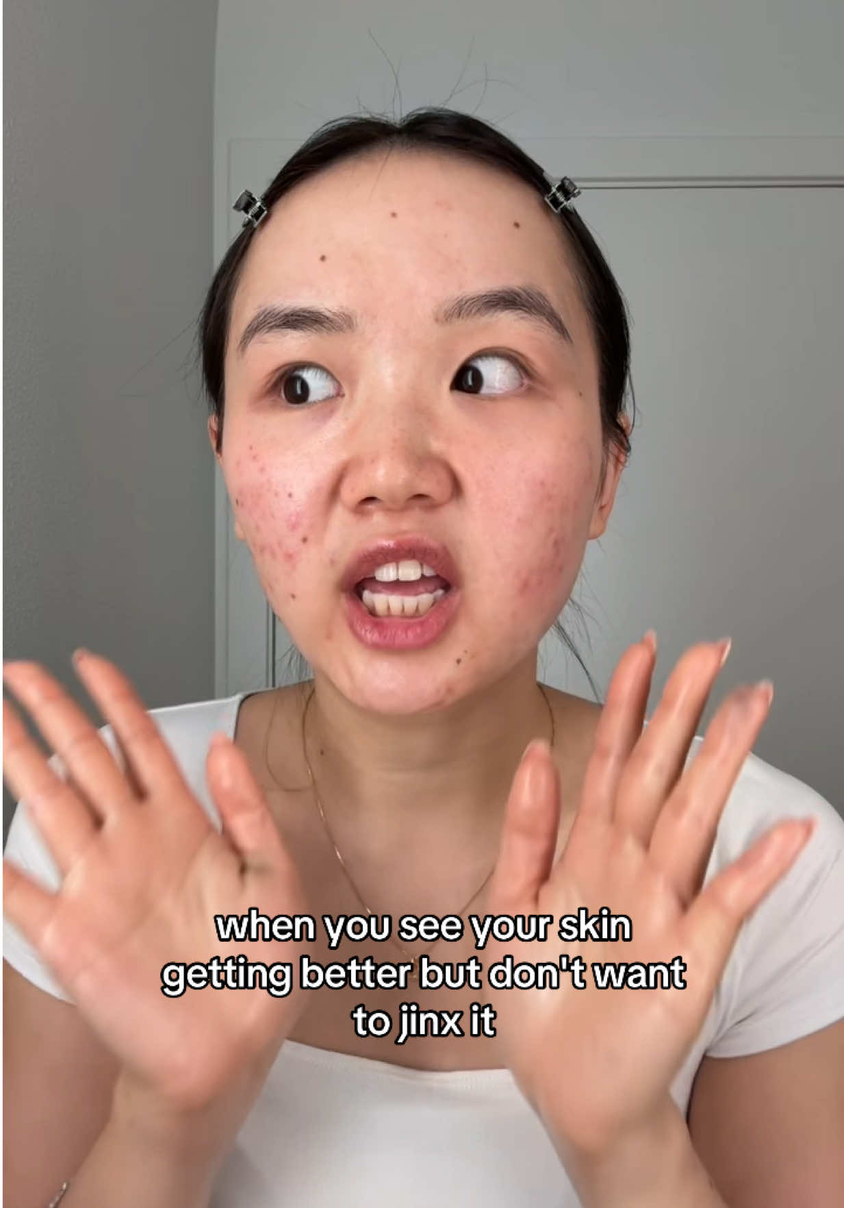 Probably jinxed myself already 🥲 #acne #relatable #jinx #acneproblems #clearskin #acnejourney 