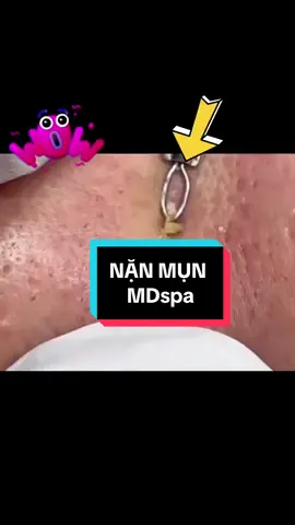 #nặn_mụn #lêthithuydung616 #chuyên_đtri_mụn_rỗ_tpvinh_nghệan #chuyên_đtri_sẹo_tpvinh #mdspa_chuyên_mụn_rỗ_tpvinh 