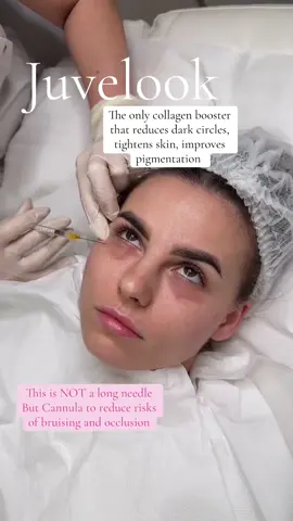 Collagen Biostimulators stimulate natural collagen production for gradual, long-lasting skin rejuvenation. Unlike HA fillers, they don’t add instant volume but trigger fibroblasts to rebuild skin structure over time. Key Treatments: 	•	Sculptra® (PLLA): Restores facial volume over months. 	•	Lanluma® (PLLA): Similar to Sculptra, also for body contouring. 	•	Lenisna® (PLLA): Korean option for facial rejuvenation. 	•	Juvelook® (PLLA): Subtle facial volumizer. How They Work: 	•	Injected to stimulate collagen via micro-injuries. 	•	Results in 4–6 weeks, peak at 3–6 months, last 1–2+ years. 	•	Ideal for volume loss, wrinkles, and skin laxity. Pros: ✔ Natural, long-lasting results ✔ Fewer touch-ups vs. HA fillers Side Effects: Mild swelling, bruising, rare nodules. HA vs. Biostimulators: 	•	HA Fillers: Instant results, last 6–12 months 	•	Biostimulators: Gradual results, longer-lasting structure #juvelook #melasma #pigmentationtreatment #skinlightening #darkcircles #skincaretips #collagenbiostimulators #sculptra #undereyebags #darkcirclesundereyes #londonskinclinic 