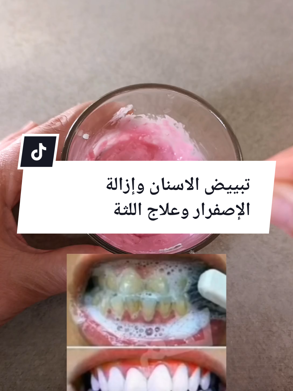 #وصفة لتبييض الاسنان وإزالة الإصفرار وعلاج اللثة#تنضيف-الاسنان-صحية-راءحة-الفم#اسنان#بيضاء-وصفة#طبيعية#foryou#fyp #fouryoupage #foyupage#explorepage✨ #الشعب_الصيني_ماله_حل😂😂 