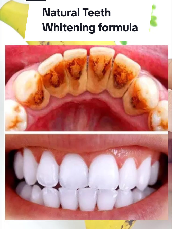 How to whiten Teeth naturally. Natural Teeth Whitening. Banana peels for Teeth Whitening. #teethwhitening #homeremedies #naturalteethwhitening #naturalrecipes #naturalremedy 