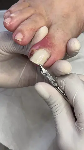 #podologasuelenreginaldo #bomretirodosul #satisfyingvideos #riograndedosul #unhas #flypシ 