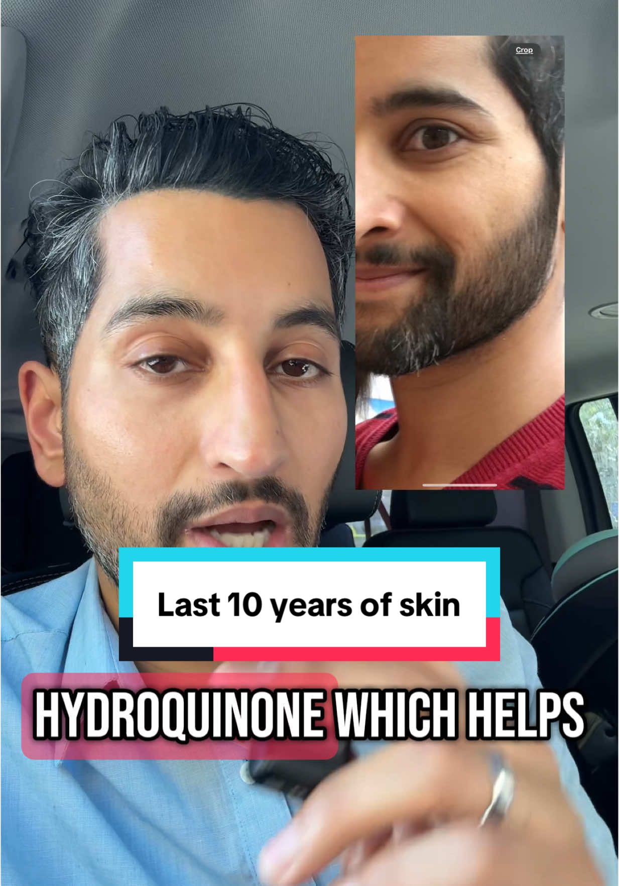 This picture wasn’t even the worst of it #drpremtripathi #wingedblepharoplasty #facialplasticsurgery #skintok 