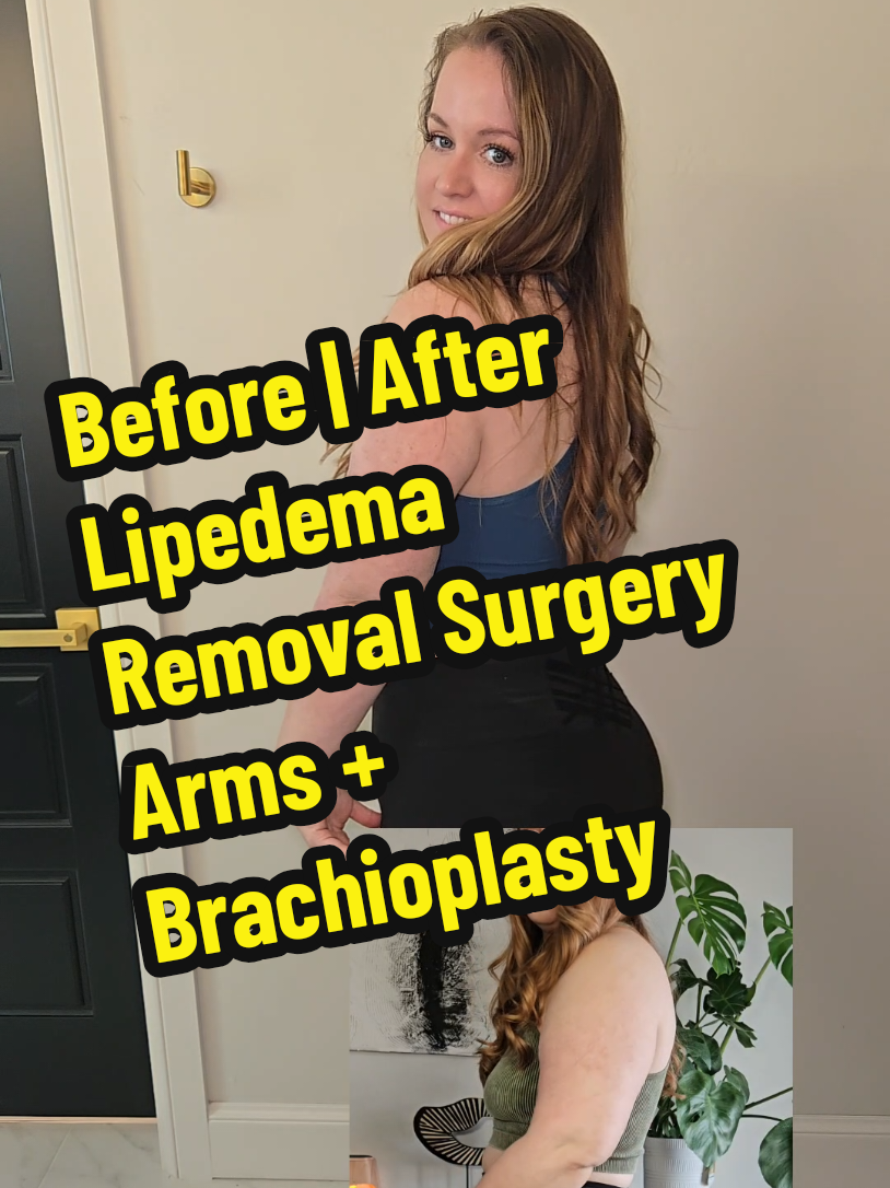 Lipedema Removal Surgery 6 week Arm Reveal. #lipedema #lipedemaremoval #lipedemasurgery #lipedemaarms #brachioplasty 