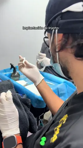 Implantación de Injerto: #cabello #injertocapilar #tratamientosparaelcabello #pelo #medico #mexico 