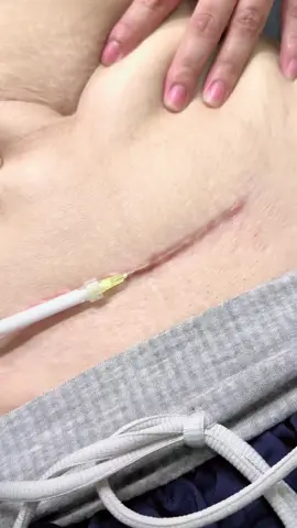 Tiêm trị sẹo lần 2 cho c khách sẹo mổ sau sinhhhh 😍😍😍 #tiêmFiller #TiêmBotox #tiêmHACollagen #MDcodeđínhcơ #tiêmquầnghốcmắt #tiemtriseoloi #tiêmtrịthâmmắt #BAPprofhilo5điểm #haiphongphoto 