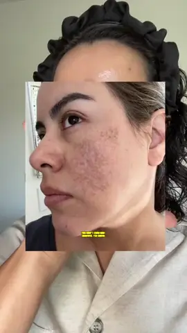 ✨ Wrinkles? Dull skin? Not on our watch. ✨ Say hello to glowing, youthful skin with Abera Skin Renewing Serum 💧 Made with saffron flower & horse chestnut extract, this antioxidant-rich formula helps fight signs of aging, boost elasticity, and lock in deep hydration 💪🌸 ✔️ All skin types ✔️ Smooths fine lines ✔️ Glowy, firm, refreshed skin Your skincare routine just got an upgrade. 💖 #AberaUS #Aberaskinrenewingserum #skincare #glowingskin #viralvideo #fypシ #fyp #darkspots #viral #melasma #melasmatreatment #trending