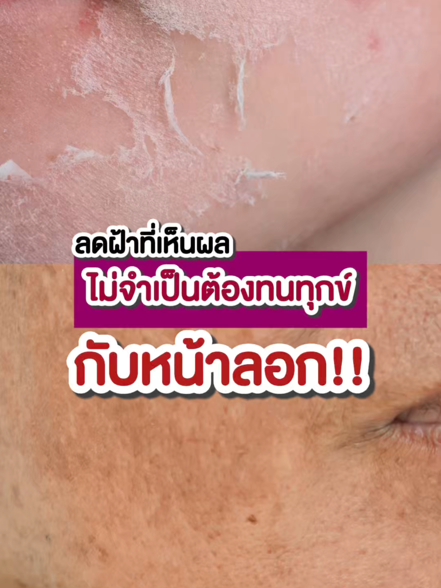 ลดฝ้าที่เห็นผลจริง ไม่จำเป็นต้องทนทุกข์กับหน้าลอก #Melamii #เมลามี่ #ฝ้า #ฝ้าซ้ำซาก #ครีมทาฝ้าเมลามี่หลอดม่วง #เซรั่มไฮยา #ผิวอิ่มฟูฉ่ําเด้ง