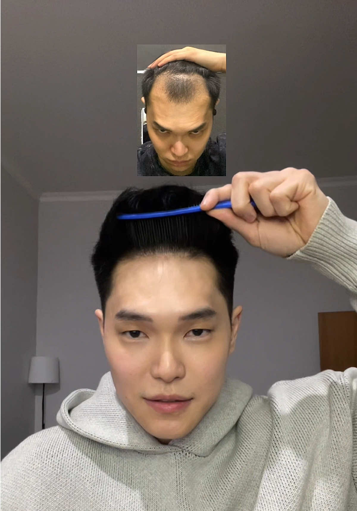 wasn’t the easiest video for me to post, but i know it might help someone out there who’s feeling the same way i did. happy to share more just lmk #hair #haircare #haircareroutine #hairtransformation #hairtransplant #hairjourney 