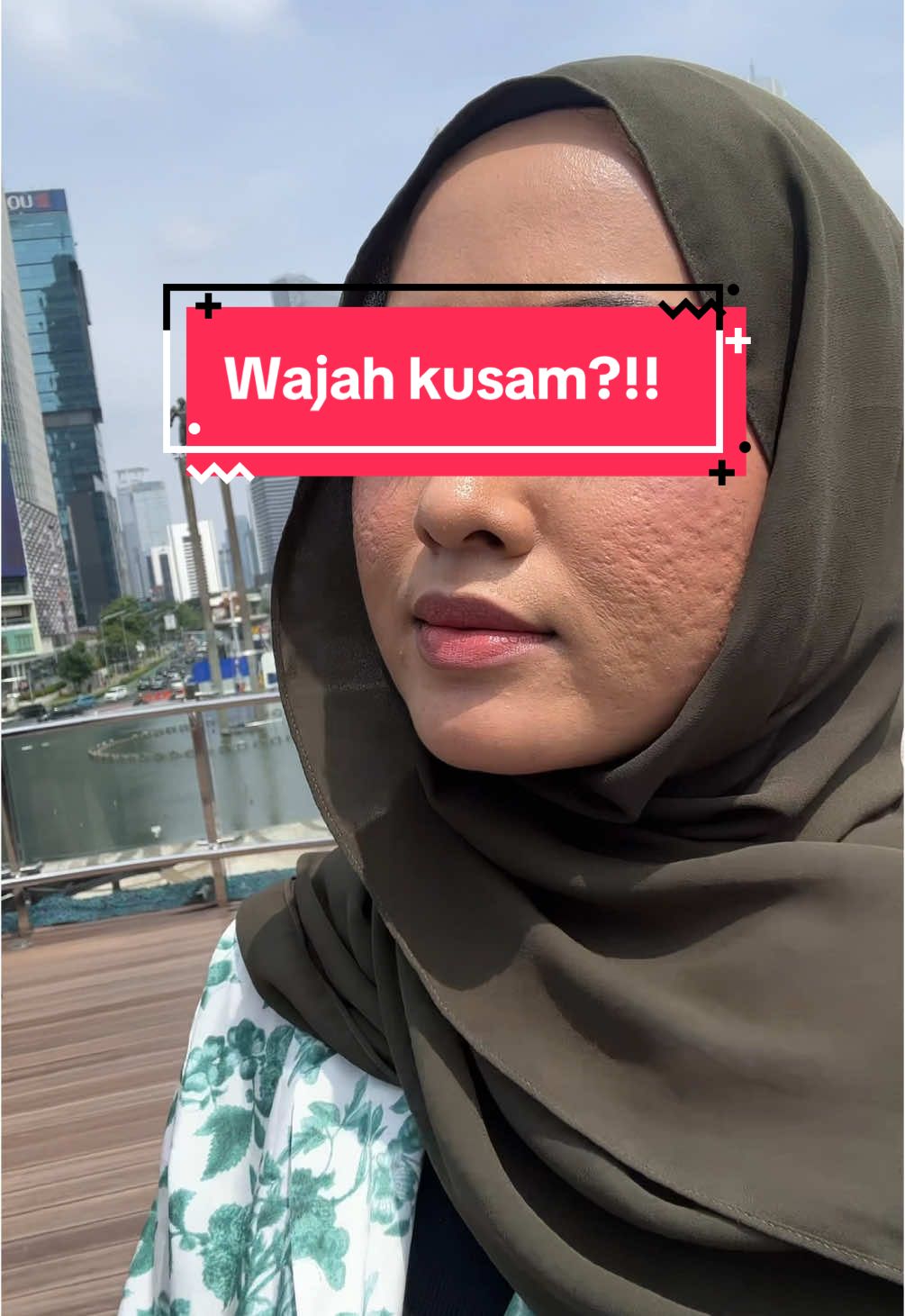 Cobain pake skincare yang kandungan nya pake highest level formula ‼️ #acnefighter ##kyurareview##reviewkyura##KyuraBeauty#Kyuraacnetoner @Kyurabeautyofficial 