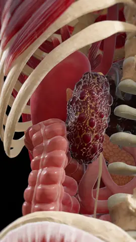 Polycystic Kidney Disease (PKD) causes cysts to grow inside your kidneys. They expand over time, reshaping the organs and slowly damaging their ability to filter blood. PKD is genetic — and it can lead to serious complications like high blood pressure, pain, and kidney failure. This 3D animation shows what PKD looks like inside the body. Based on SciePro’s anatomy model. Available for B2B licensing — link in bio. #science #medical #meded #3d #3dmodel #zbrush #sciart #medart #medstudent #anatomy #animation #scicomm #med #pkd #nephrology #polycystickidneys