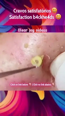 Foi aplicado um filtro neste vídeo , o tiktok não permite mostrar cor de sangue Assista mais vídeos como esse clique na playlist abaixo e aproveite !  Gostaria de ver este vídeo sem filtro ? Se inscreve na comunidade !  Clica na estrela amarela logo acima da descrição desse vídeo  👆🏻 #blackheads #pimples #pimplepopper #acne #squeeze #squeezeuk #pimplepoppersatisfying #limpezasatisfatoria #reagindo #cravos #removal #Fyu #fyp #satisfyingvideo #cyst #cystremoval #cistosebaceo #blackhead #ニキビ #クローブ #皮脂嚢胞 #嚢胞 #顔のニキビ #ニキビを取り除く #満足のいく #creatorsearchinsights
