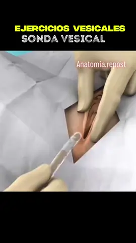 Sonda vesical 🏥👨‍⚕️#elenfermerocesar #hospital #personaldesalud #medicosdetiktok #enfermeros #medicos #enfermeria #enfermeriatiktok #enfermeras #trucosdeenfermeria #LIVEIncentiveProgram 