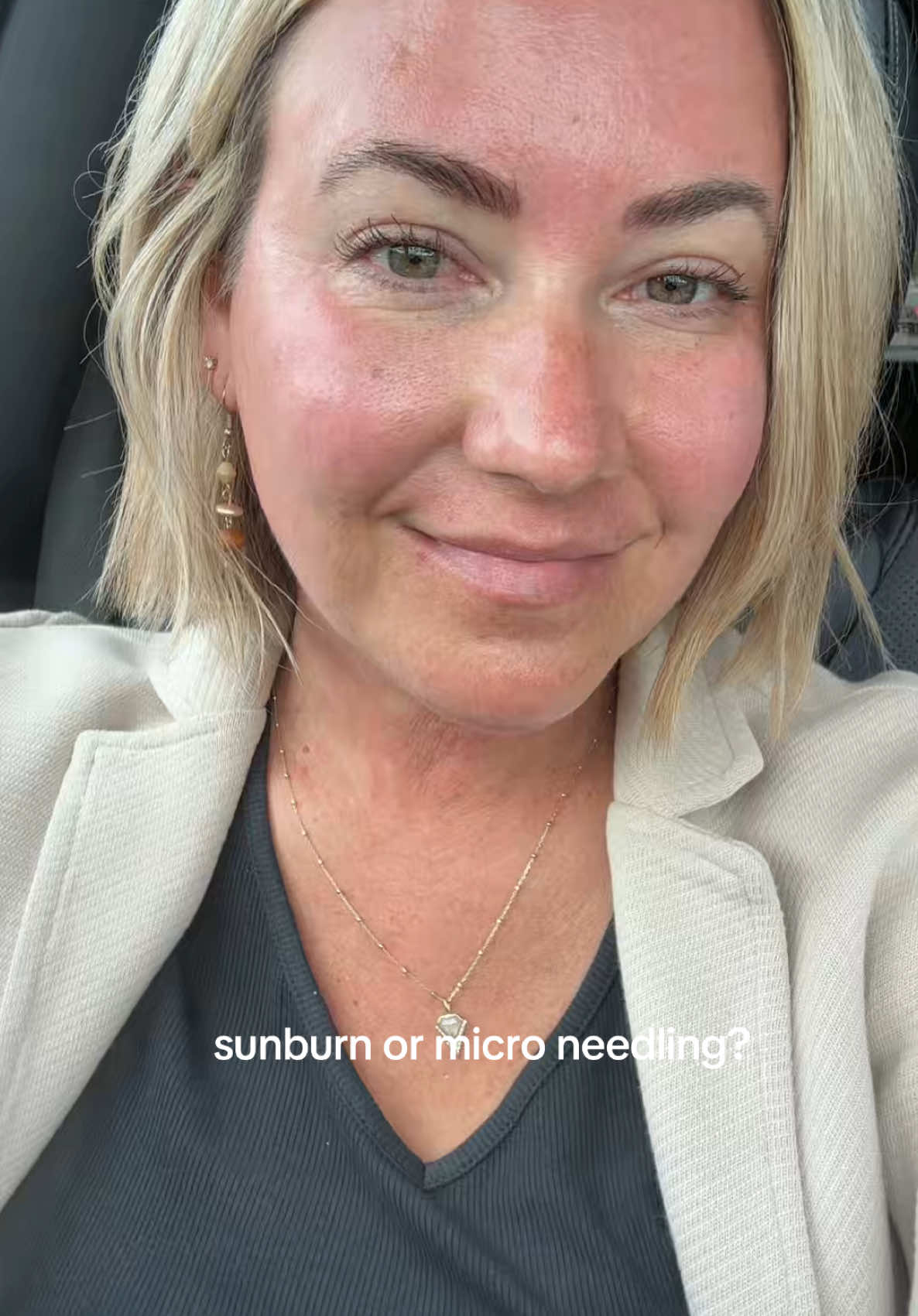 ☀️ sorta feels like a sunburn, but the results are better 🙌🏻