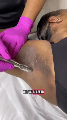 Recetinha caseira☺️ #manchasnapele #mulher #mulheres #axilaescura #dicasdepele 