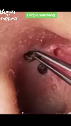 #viralvideotiktok #parati #blackheadremoval #satisfyingvideo #squeeze #foryou 