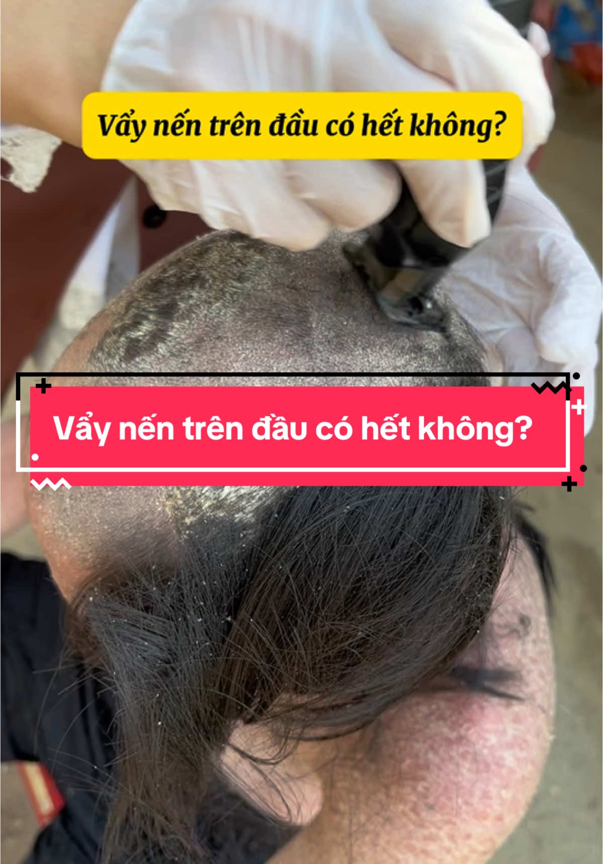 Vẩy nến trên đầu có hết không? @Thị Tuyến DC 35(2) #vẩynến #viêmdacơđịa 