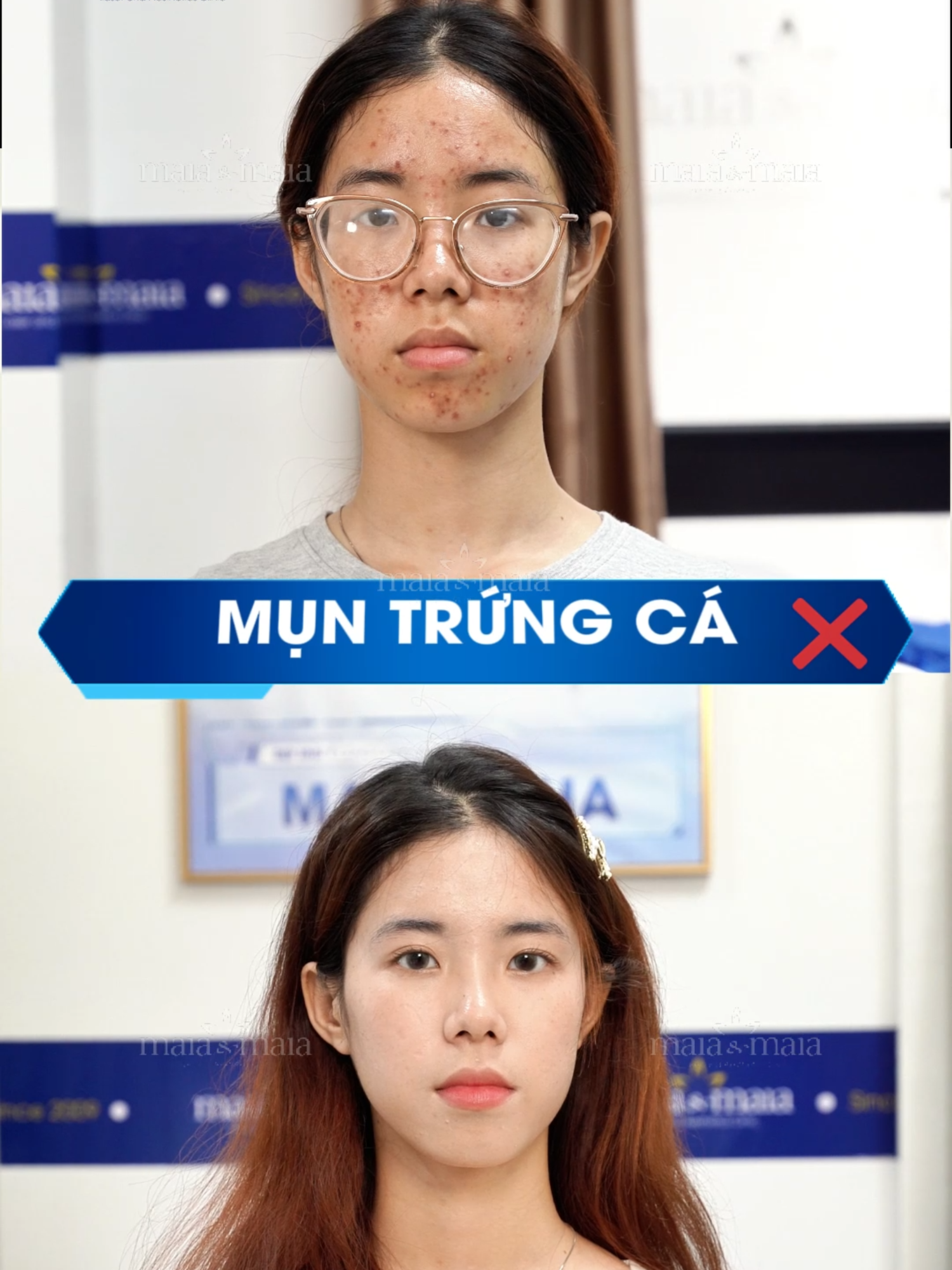 Lấy lại sự tự tin sau 1 liệu trình Trị Mụn tại phòng khám Maia. Chỉ từ 350K - Tạm biệt mụn thâm sau 3 Buổi! Hiện Phòng khám đang có Ưu đãi dành riêng Tháng 5: - Giảm giá 50% & Hỗ trợ đi lại cho HSSV. - Miễn phí 100% dịch vụ soi khám da VISIA. - Voucher Giảm Giá 450K. Còn 55 Suất - Đăng Kí Ngay! #mụn #trịmụn #phongkhamdalieu #maia #lamdep #skincare #mụn_ẩn #mụn_đầu_đen #mụn_trứng_cá #sẹorỗ #mụn_dậy_thì #thâm_mụn #fyp #xuhướng #viral #bacsihoan #trimun