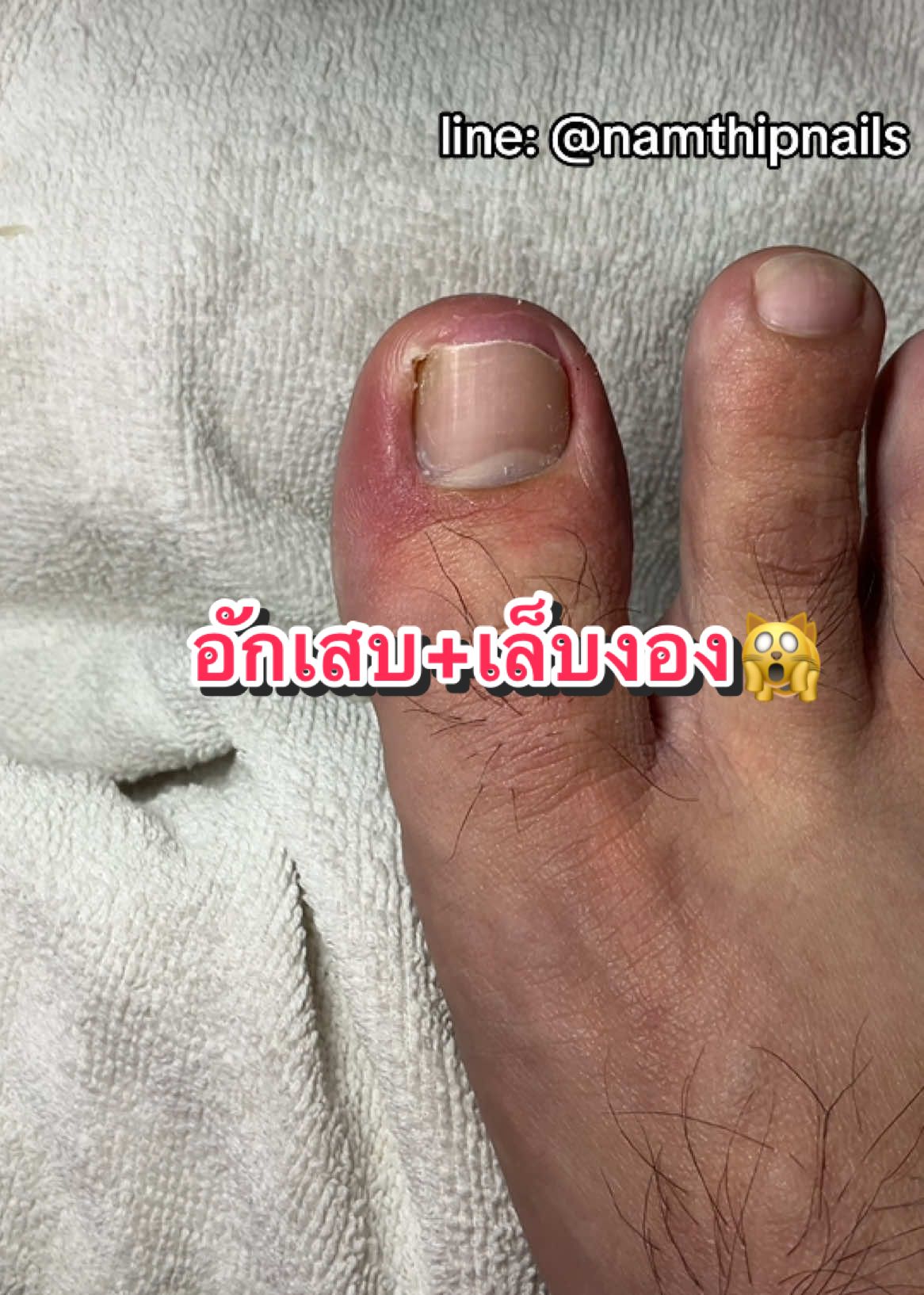 💓 #namthipnails #ตัดเล็บขบ #ตัดหนัง #ทำเล็บ #ร้านตัดเล็บขบ #ร้านตัดเล็บขบราม2 #ตัดเล็บ #เล็บขบ  #เล็บเชื้อรา Fb : namthipnails  Line : @namthipnails  นัมเบอร์วัน8 ตลาดม.ราม2  กทม  Map: namthipnails  https://goo.gl/maps/JmwpCKLfKwmhKGK96  ร้านเปิดทุกวัน เวลา12.00น-22.00น.