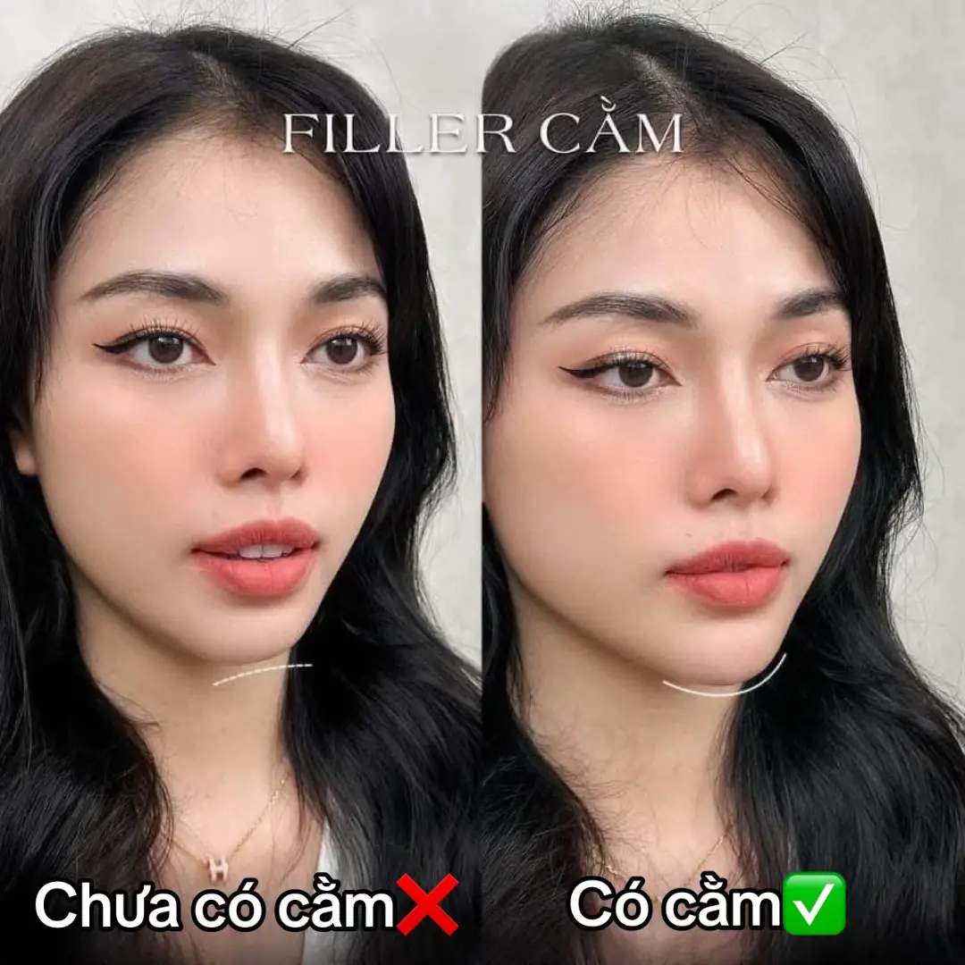 Thiếu gì cũng được xin đừng thiếu cằm mấy c ơi 😀😀 ⚜️𝐓𝐈𝐄̂𝐌 𝐂𝐀̆̀𝐌⚜️ Chỉ 1cc có ngay một chiếc cằm hài hoà với khuôn mặt 😍 THỜI GIAN THỰC HIỆN NHANH, KHÔNG ĐAU, KHÔNG SƯNG. CHỈ MẤT 15 PHÚT THỰC HIỆN ✔️𝗧𝗶𝗲̂𝗺 𝗳𝗶𝗹𝗹𝗲𝗿 𝗰𝗮̆̀𝗺 𝗹𝗮̀ 𝗽𝗵𝘂̛𝗼̛𝗻𝗴 𝗽𝗵𝗮́𝗽 𝘁𝗵𝗮̂̉𝗺 𝗺𝘆̃ 𝗸𝗵𝗼̂𝗻𝗴 𝗽𝗵𝗮̂̃𝘂 𝘁𝗵𝘂𝗮̣̂𝘁 𝗴𝗶𝘂́𝗽 𝗻𝗮̀𝗻𝗴 𝘀𝗼̛̉ 𝗵𝘂̛̃𝘂 𝗰𝗮̆̀𝗺 𝘁𝗿𝗼̀𝗻 𝘁𝗮̀𝗶 𝗹𝗼̣̂𝗰 𝗻𝗵𝗮𝗻𝗵 𝗰𝗵𝗼́𝗻𝗴 𝗻𝗵𝗮̂́𝘁. 𝗧𝗶𝗲̂𝗺 𝗳𝗶𝗹𝗹𝗲𝗿 𝗰𝗮̆̀𝗺 𝗽𝗵𝘂̀ 𝗵𝗼̛̣𝗽 𝗰𝗵𝗼 𝗻𝗵𝘂̛̃𝗻𝗴 𝗻𝗴𝘂̛𝗼̛̀𝗶: 👉 𝐶𝑜́ 𝑐𝑎̆̀𝑚 𝑙𝑒̣𝑚, 𝑐𝑎̆̀𝑚 𝑚𝑜̉𝑛𝑔, 𝑐𝑎̆̀𝑚 𝑛𝑔𝑎̆́𝑛. 👉 𝐶𝑎̆̀𝑚 𝑏𝑖̣ 𝑣𝑒̣𝑜 ℎ𝑎𝑦 𝑏𝑖̣ 𝑙𝑒̣̂𝑐ℎ. 👉 𝑁ℎ𝑢̛̃𝑛𝑔 𝑛𝑔𝑢̛𝑜̛̀𝑖 𝑚𝑢𝑜̂́𝑛 𝑠𝑜̛̉ ℎ𝑢̛̃𝑢 𝑚𝑜̣̂𝑡 𝑐ℎ𝑖𝑒̂́𝑐 𝑐𝑎̆̀𝑚 𝑡ℎ𝑜𝑛 𝑔𝑜̣𝑛, ℎ𝑎̀𝑖 ℎ𝑜̀𝑎 ℎ𝑜̛𝑛 𝑣𝑜̛́𝑖 𝑘ℎ𝑢𝑜̂𝑛 #tiêmcằm  #tiêmcằmtròntàilộc #tiemfillerphuquoc 