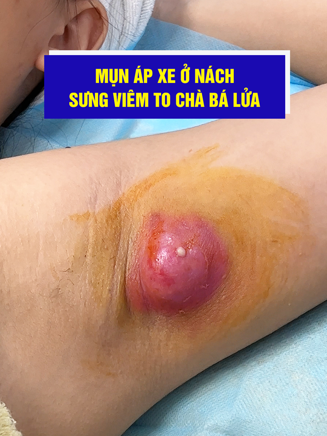 Lấy nhân mụn áp xe ( sưng viêm sau 10 ngày ) siêu to khổng lồ #dieutrimun #nặn_mụn #mụn_viêm #mụn_áp_xe #foryou #pimples #nặnmụnbằngtay #nặn_mụn_chuẩn_y_khoa #hhvclinic #hochiminh