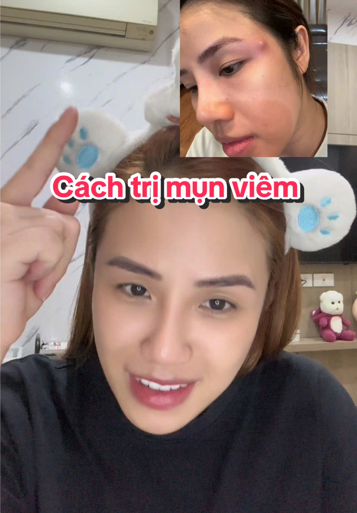 Cách mà mình đã dùng để trị mụn viêm sưng to 😭😭 #detoxblanc #mask #dadau #peelacnesblanc #chamsocda #chamsocdamun #xuhuong #chit93review 