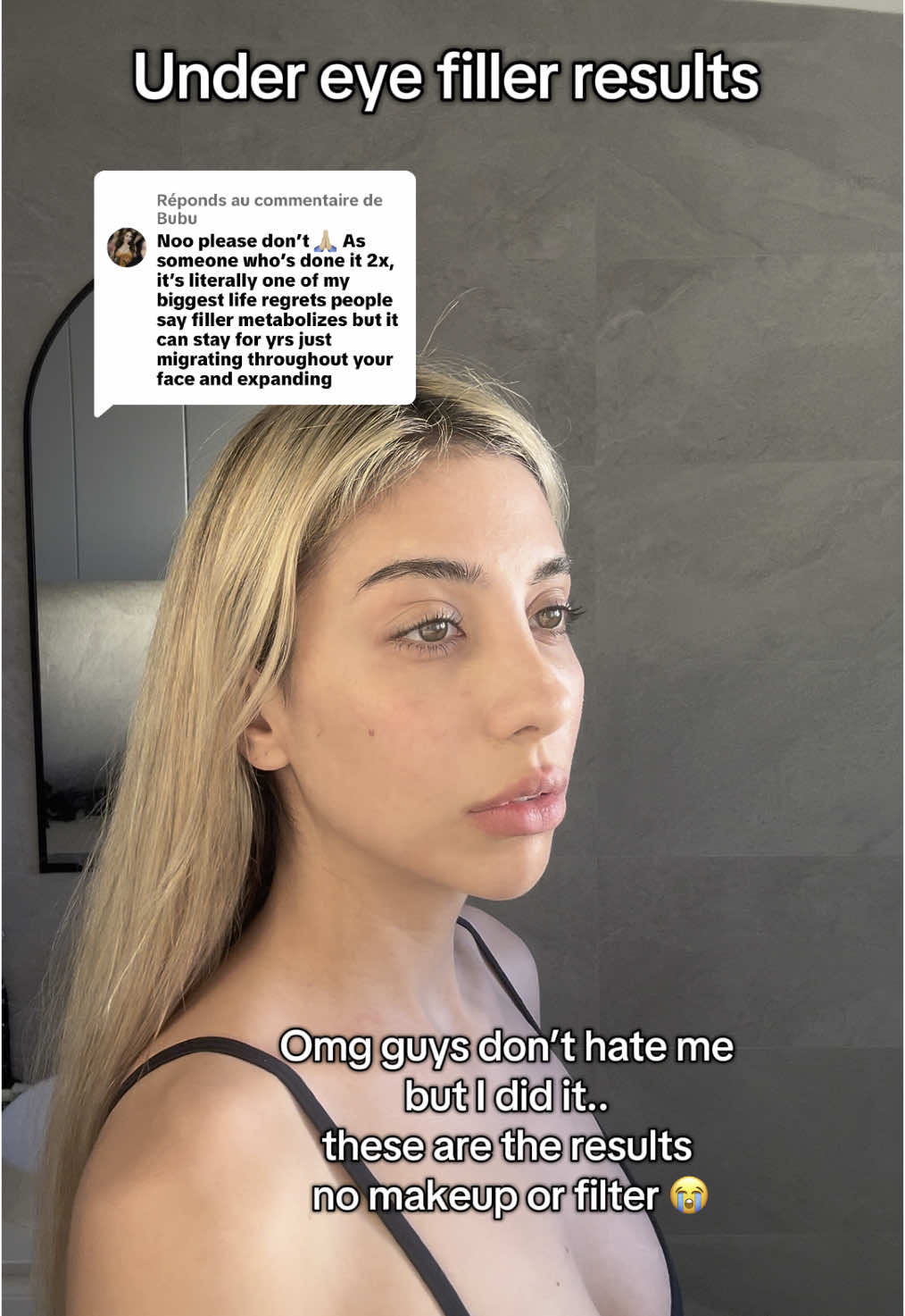 Réponse à @Bubu under eye filler results…. This is just because PRP treatment didn’t work for me #undereyecircles #undereyefiller #prpundereyetreatment 