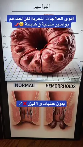 #بواسير_خارجية #healthy #بواسير_داخلية #الناسور_الشرجي #الناسور_العصعصي #مرض #الناسور #بواسير #شرخ #fyp #اكسبلورexplore_o #صحة_عامة #الشعب_الصيني_ماله_حل😂😂 #الشعب_الصيني_ماله_حل😂😂🙋🏻‍♂️ #life #اكسبلورexplore❥🕊 #ارشادات #نصائح #اكزيما_الجلد_عن_الكبار_والصغار #اكزيما