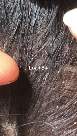 clean up all the itch #omg😱😱 #lice #😱😱😱 #trending 