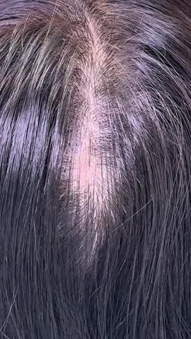 Eu achava que esse redemoinho no meu couro cabeludo não tinha solução… Era uma insegurança principalmente quando tinha algum evento para ir.  Até conhecer essa técnica da @Yoná Hamada . Resultado natural, duradouro e zero dor. Fiquei muito feliz com o resultado! Já conhecia a nano capilar? Me conta aqui nos comentários! #NanoCapilar #MicropigmentaçãoCapilar #VolumeCapilar #CicatrizNoCouroCabeludo #QuedaDeCabelo #RedemoinhoNoCabelo #Autocuidado #BelezaReal #ConfiançaFeminina #ProcedimentoEstético #CabeloComVolume #SkincareCapilar #TransformaçãoCapilar #AntesEDepois