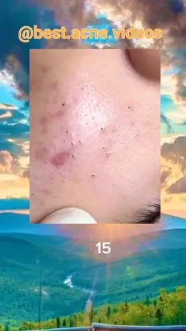 #squeezeyuk #boutons #pimplepop #blackhead 