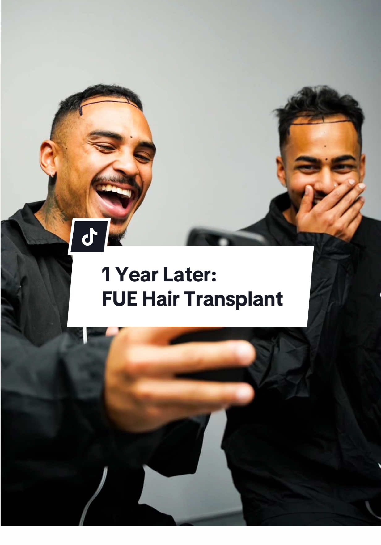 1 YEAR LATER: FUE Hair Transplant with Alvi Armani.  @Alvi Armani SA @asadboomgaard  A year later, and I can’t believe how good the results are! I could not recommend this procedure more.. I’ve never felt more confident with how I look as I do now. If you have any hair concerns, go and get a consult done, there are many options available for you, not just a transplant.  #hair #hairtransplant #fuehairtransplant #alviarmani #menshair #hairgrowthjourney #hairtransplantsurgery 