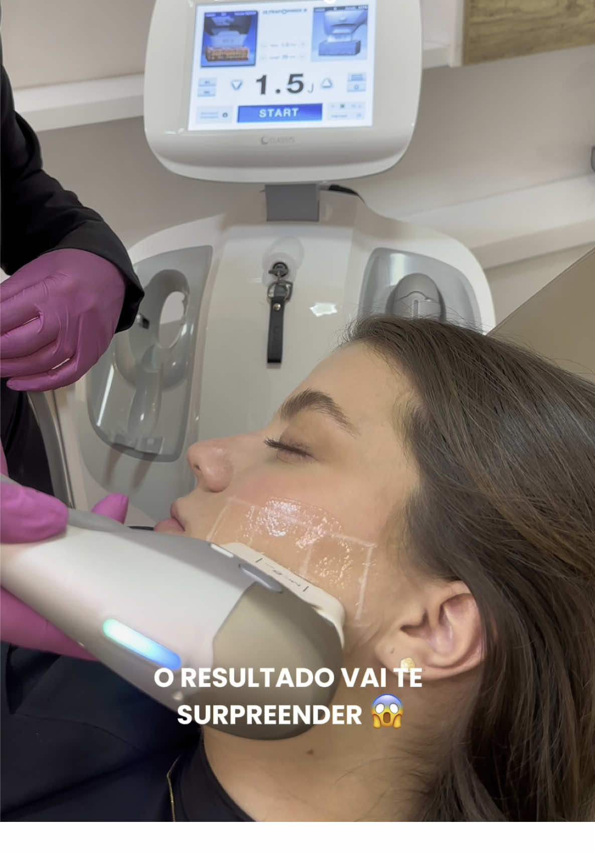 Você sofre com papada e gostaria de ter um rosto mais fino? Saiba mais sobre o nosso queridinho Ultraformer III ❤️ Definição de contorno ✅ Redução de papada ✅ Efeito bichectomia sem necessidade de cirurgia ou cortes ✅ #papadagoiania #comoreduzirpapada #bichectomia #ultraformergoiania #ultraformer3 #efeitobichectomia